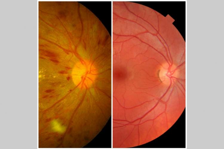 La rétinopathie diabétique : Première cause de cécité