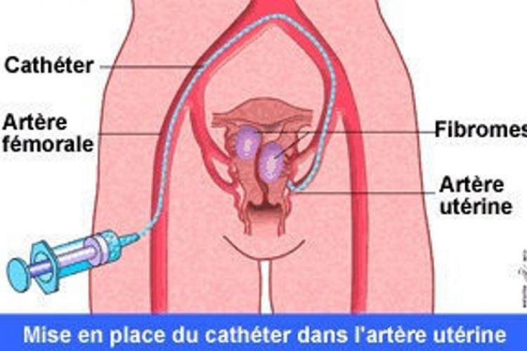 Fibrome utérin : L'embolisation, une solution définitive